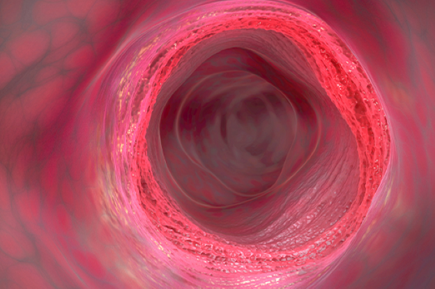Intestinal Inflammation image Intestinal Inflammation